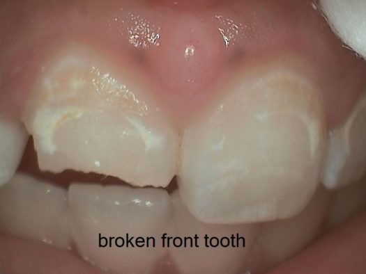 large-STOE_broken-tooth-before large-STOE_broken-tooth-before